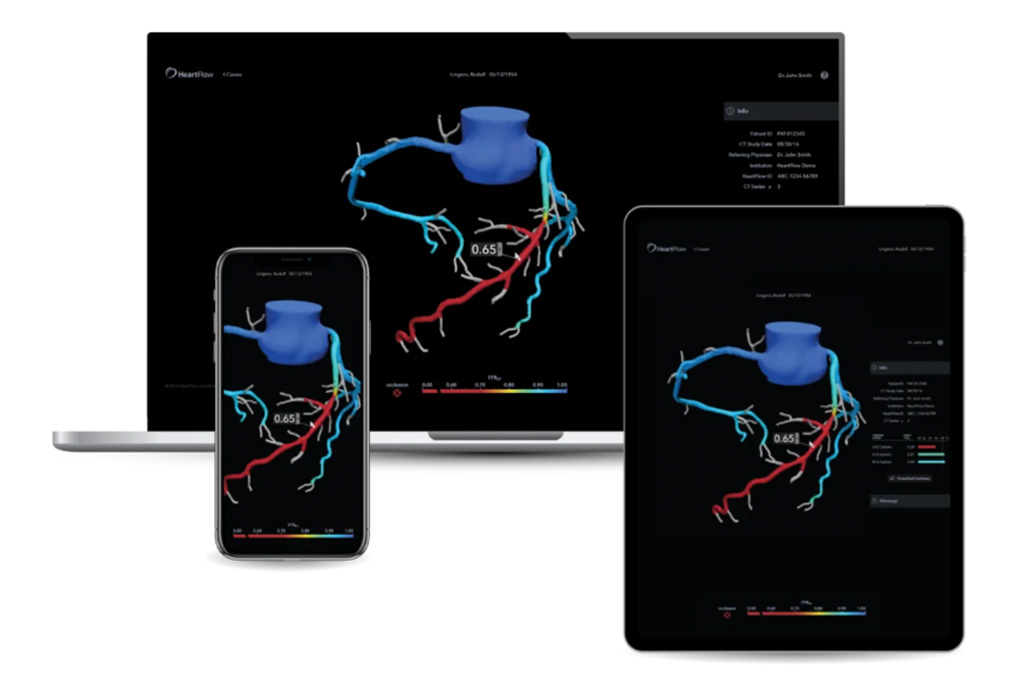 An angiogram scan shown on mobile, tablet and laptop devices